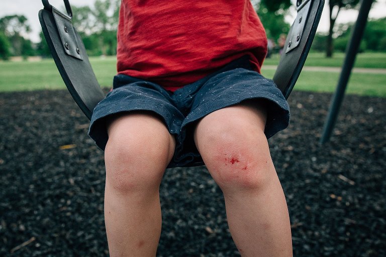 Boy has skinned knee on park swings.